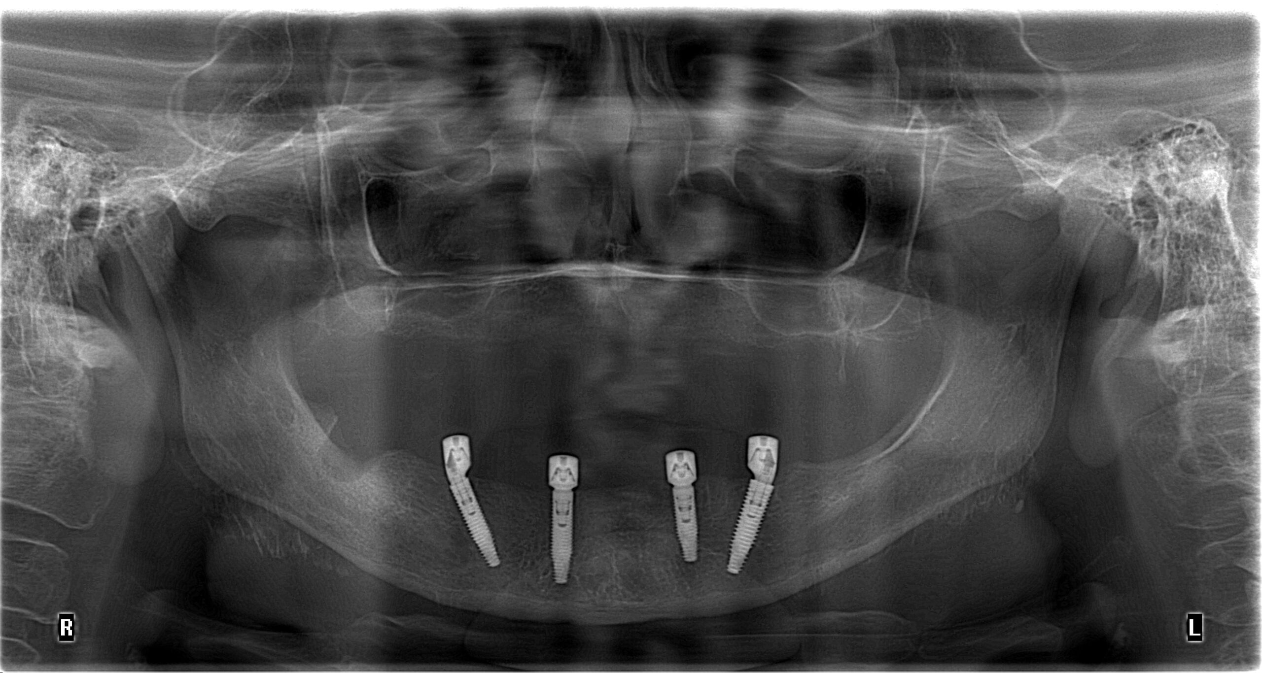 Permite la evaluación de terceros molares, presencia de dientes retenidos, lesiones residuales y restos radiculares, permite ver anomalías del desarrollo, posición, desarrollo y forma de los dientes. Además, permite ver traumatismos maxilofaciales, y lesiones óseas extensas.