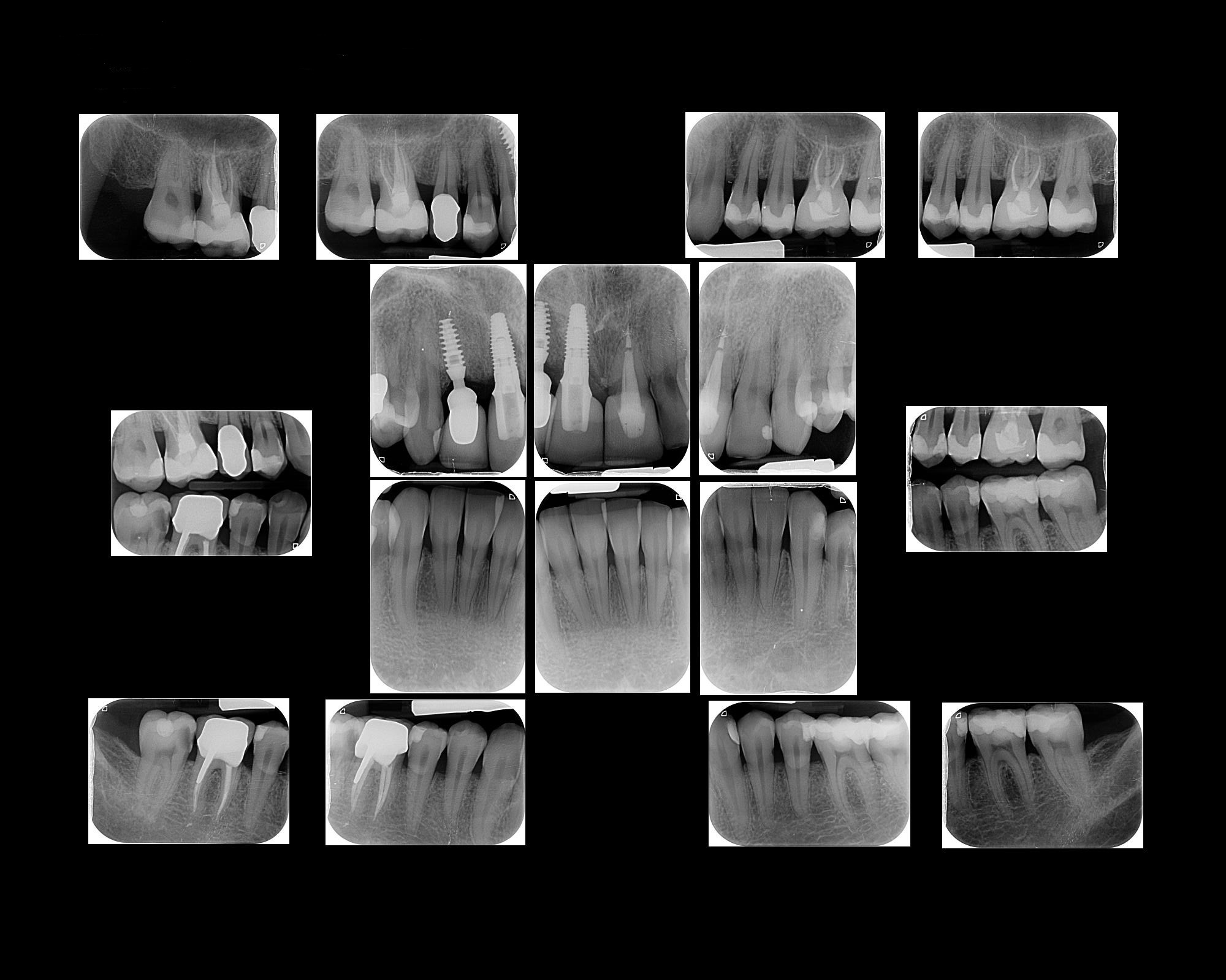 la serie periapical, es un estudio completo de los dientes y de sus estructuras más cercanas.