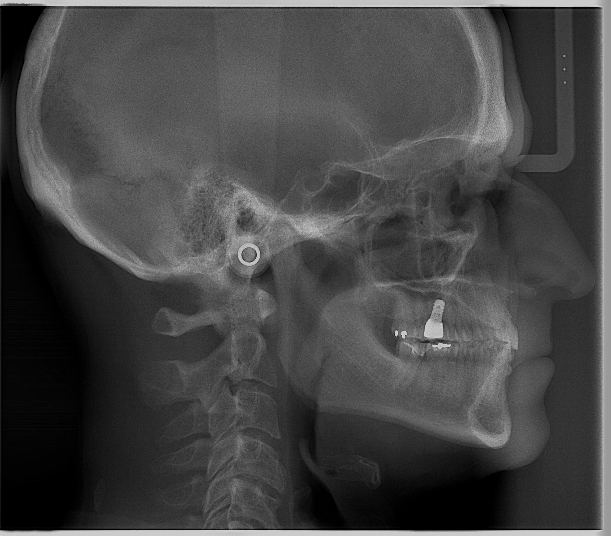 Permite la evaluación de la vía aérea, integridad de la bóveda palatina, ver senos paranasales y paladar duro, cefalometría y la impresión lateral de la columna cervical.