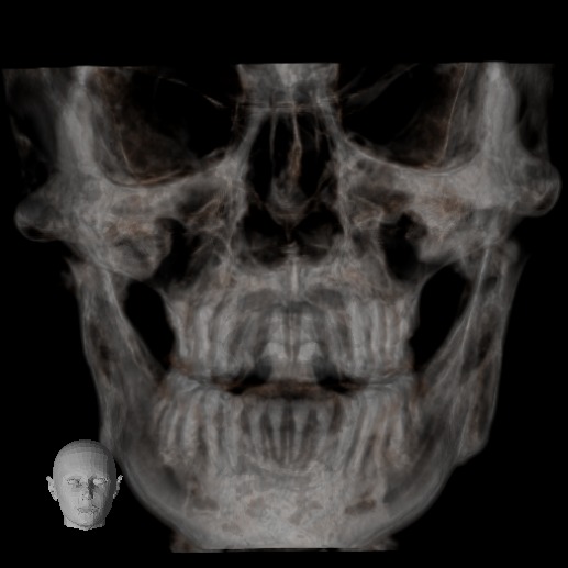 La TC Cone Beam es una tecnología que permite el escaneado y la adquisición de volumen especifico de la cabeza del paciente y que genera datos en 3D. La TC Cone Beam presenta numerosas ventajas sobre las otras modalidades de exámenes por imágenes debido a su exactitud, a su alta velocidad de escaneado y a su seguridad.