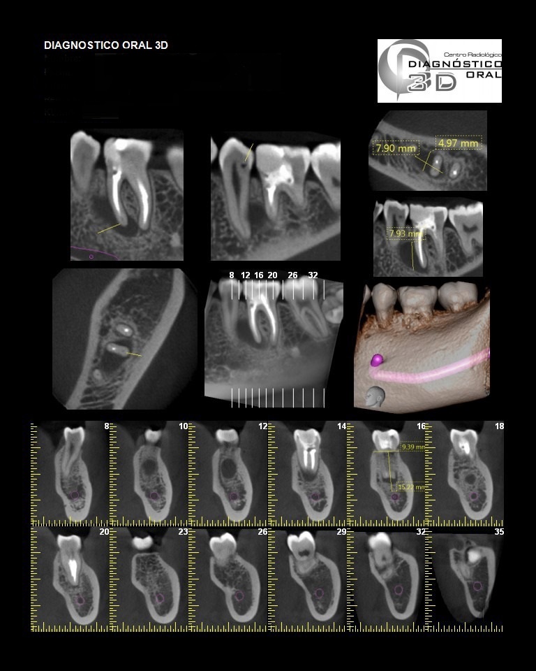 A través de estos años se ha encontrado que este sistema permite mostrar aquellos conductos que con una radiografía periapical no podemos observar, fracturas radiculares, reabsorciones internas y externas, todo esto es posible gracias al espesor del corte que podemos lograr desde  0.125 mm hasta 5 mm, lo que nos indica que la imagen fue adquirida con una matriz compuesta por voxels   isotrópicos de 125 micras.