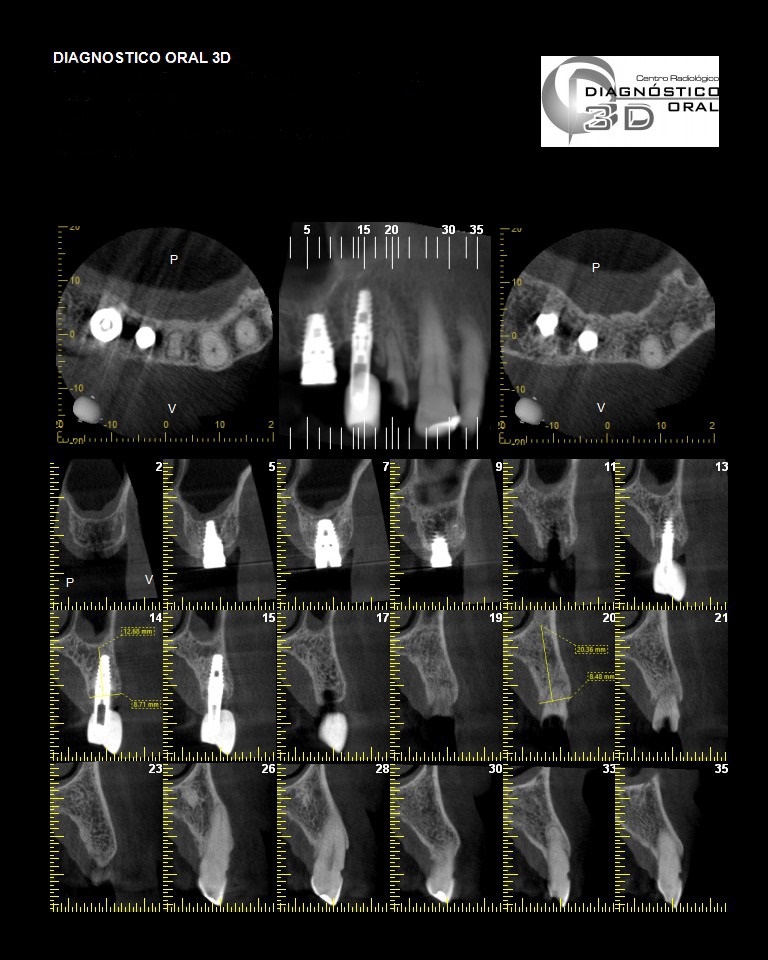 Es importante tanto para el profesional como para el paciente, saber si hay hueso disponible para la ubicación de los implantes, de que longitud pueden ser según la altura, que diámetro deben tener según el espesor y el ancho  óseo y que calidad de hueso los va a recibir para posteriormente lograr una osteointegración de la estructura. Este tipo de información solo puede lograrse completamente con una imagen 3D.