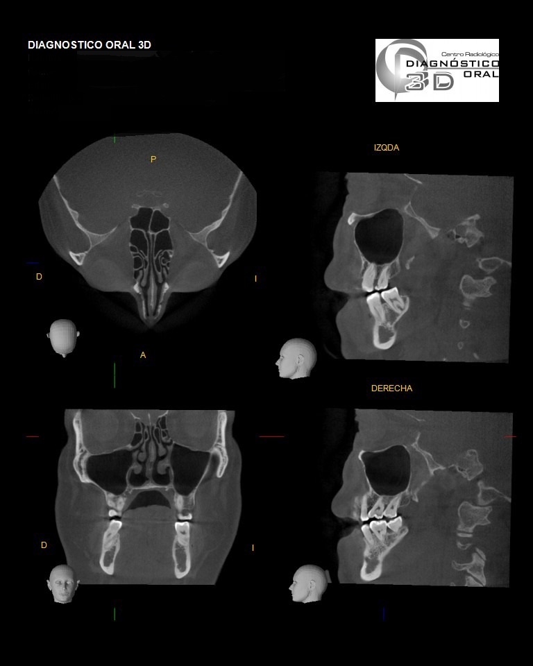 A través de estos años se ha encontrado que este sistema permite mostrar aquellos conductos que con una radiografía periapical no podemos observar, fracturas radiculares, reabsorciones internas y externas, todo esto es posible gracias al espesor del corte que podemos lograr desde  0.125 mm hasta 5 mm, lo que nos indica que la imagen fue adquirida con una matriz compuesta por voxels   isotrópicos de 125 micras.